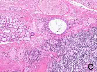 Figure 1.  HE stains in the pancreas, the thyroid gland and the tonsil. Numerous lymphocytes were stained around the lobes of the pancreatic exocrine cells (1-A), inter-spaces of colloidal cells of the thyroid gland (1-B) and around the tonsil by HE stain (1-C). The beta cells in the pancreatic islet were practically destroyed (1-D). The infiltration manner of lymphocytes in the thyroid gland is different from that of Hashimoto disease. [Click all pictures to enlarge]