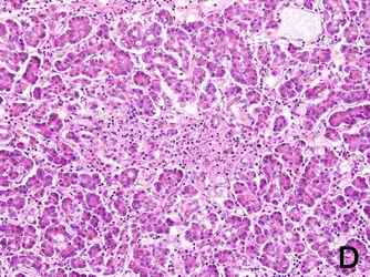 Figure 1.  HE stains in the pancreas, the thyroid gland and the tonsil. Numerous lymphocytes were stained around the lobes of the pancreatic exocrine cells (1-A), inter-spaces of colloidal cells of the thyroid gland (1-B) and around the tonsil by HE stain (1-C). The beta cells in the pancreatic islet were practically destroyed (1-D). The infiltration manner of lymphocytes in the thyroid gland is different from that of Hashimoto disease. [Click all pictures to enlarge]