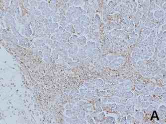 Figure 2. Staining results of the pancreas and with antibodies against surface antigens of lymphocytes, CD3, CD4 and insulin. Large amount of lymphocytes was observed around the lobes of pancreatic exocrine cells but not in islet cells (2-A). Small amount of T cells were detected by anti CD3 or CD4 around the lobes of pancreatic exocrine cells but not in islet cells (2-B and 2-C). [Click all pictures to enlarge]