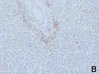 Figure 2. Staining results of the pancreas and with antibodies against surface antigens of lymphocytes, CD3, CD4 and insulin. Large amount of lymphocytes was observed around the lobes of pancreatic exocrine cells but not in islet cells (2-A). Small amount of T cells were detected by anti CD3 or CD4 around the lobes of pancreatic exocrine cells but not in islet cells (2-B and 2-C). [Click all pictures to enlarge]