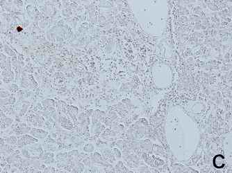 Figure 2. Staining results of the pancreas and with antibodies against surface antigens of lymphocytes, CD3, CD4 and insulin. Large amount of lymphocytes was observed around the lobes of pancreatic exocrine cells but not in islet cells (2-A). Small amount of T cells were detected by anti CD3 or CD4 around the lobes of pancreatic exocrine cells but not in islet cells (2-B and 2-C). [Click all pictures to enlarge]