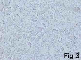 Figure 3. Staining results of the pancreas with anti-insulin antibody. No reactivity with anti-insulin was observed in the pancreas (3-A). [Click all pictures to enlarge]