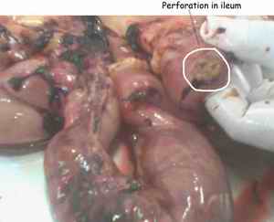 Figure 1. Perforation in ileum