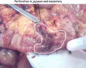 Figure 2. Perforation in jejunum and mesentery