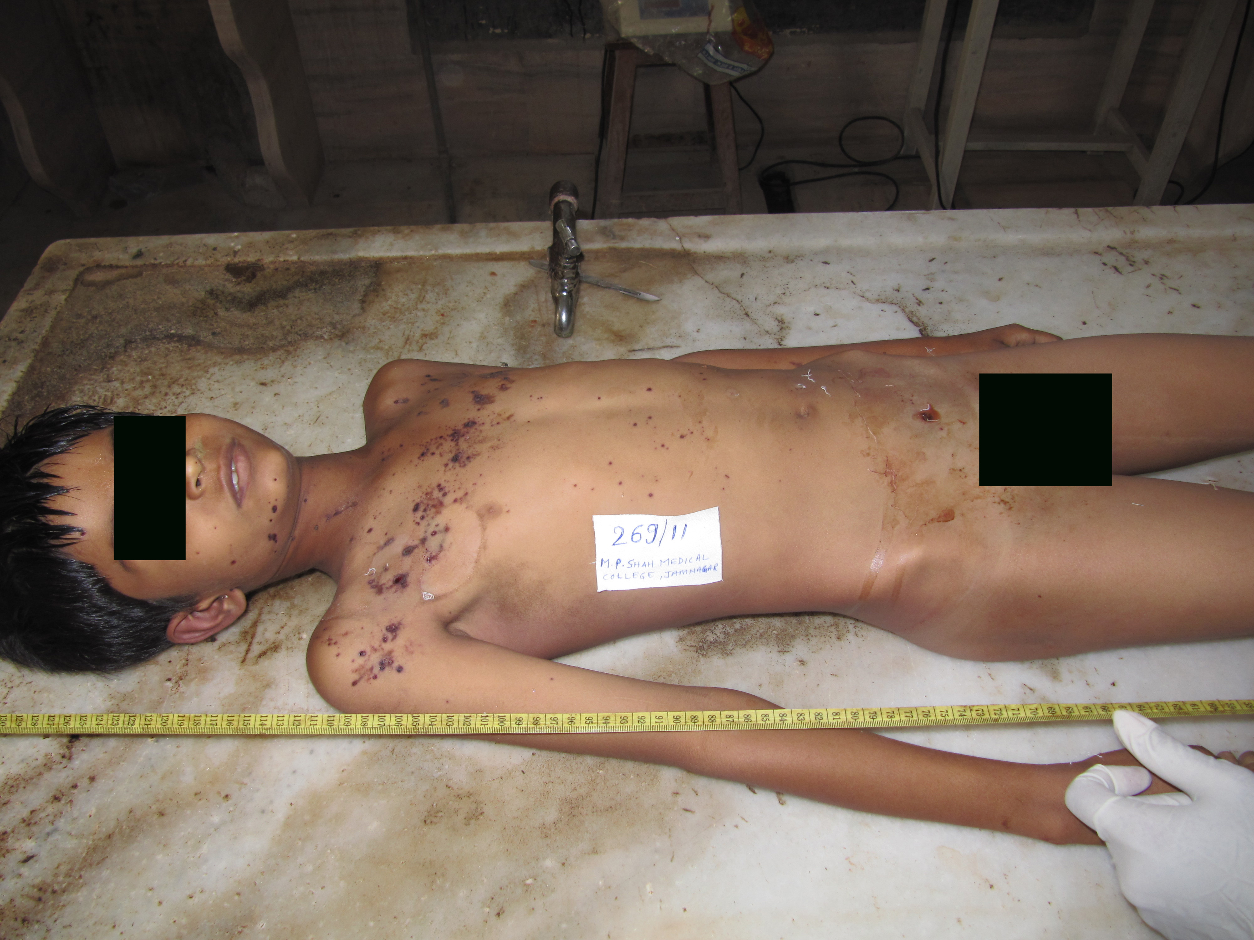 poster 1 - Multiple scars of varying age- Self inflicted healed injuries in a psychiatric person