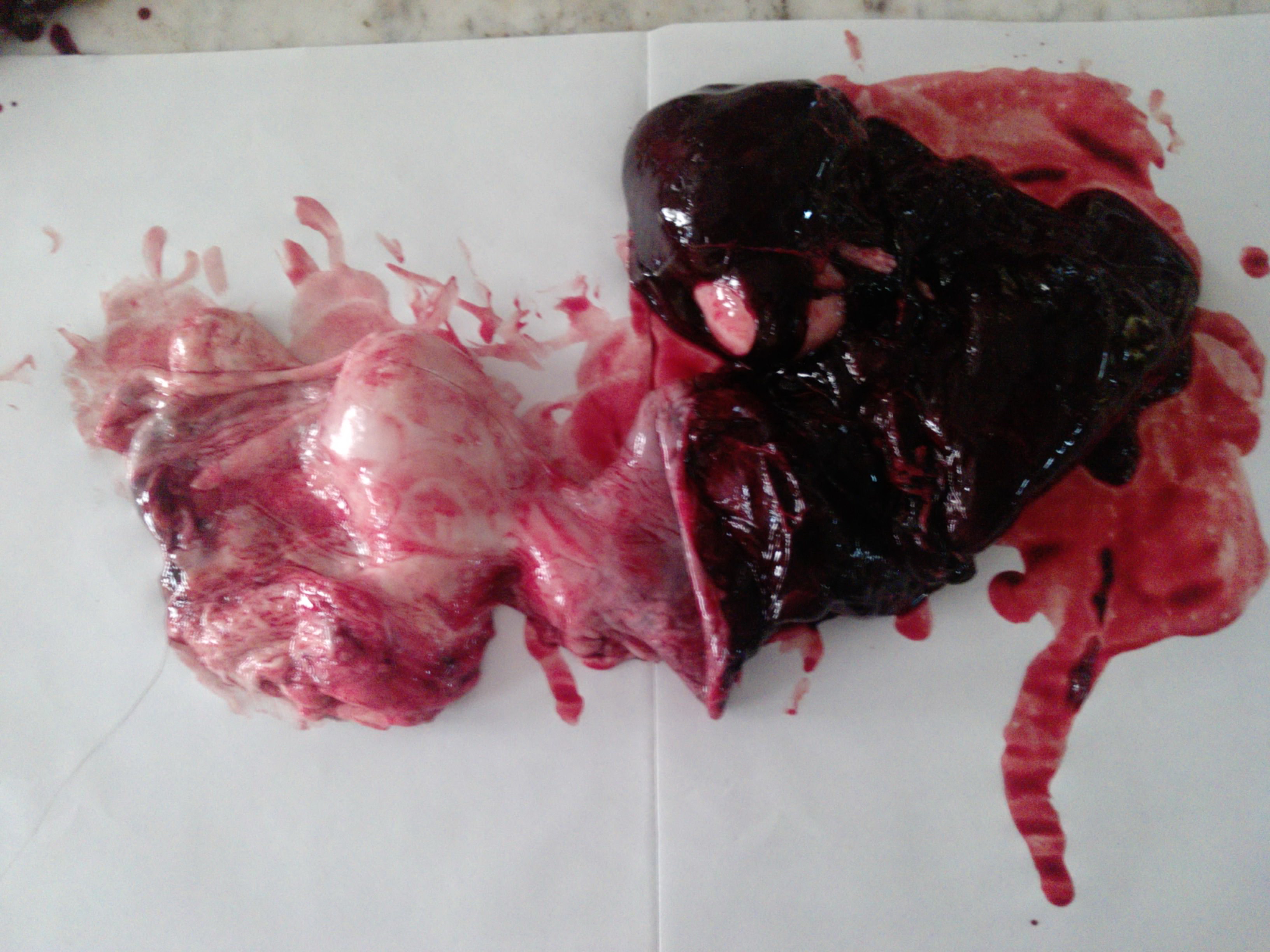 poster 2 - Traumatic transection of aorta and also attempted erasure of tattoo marks