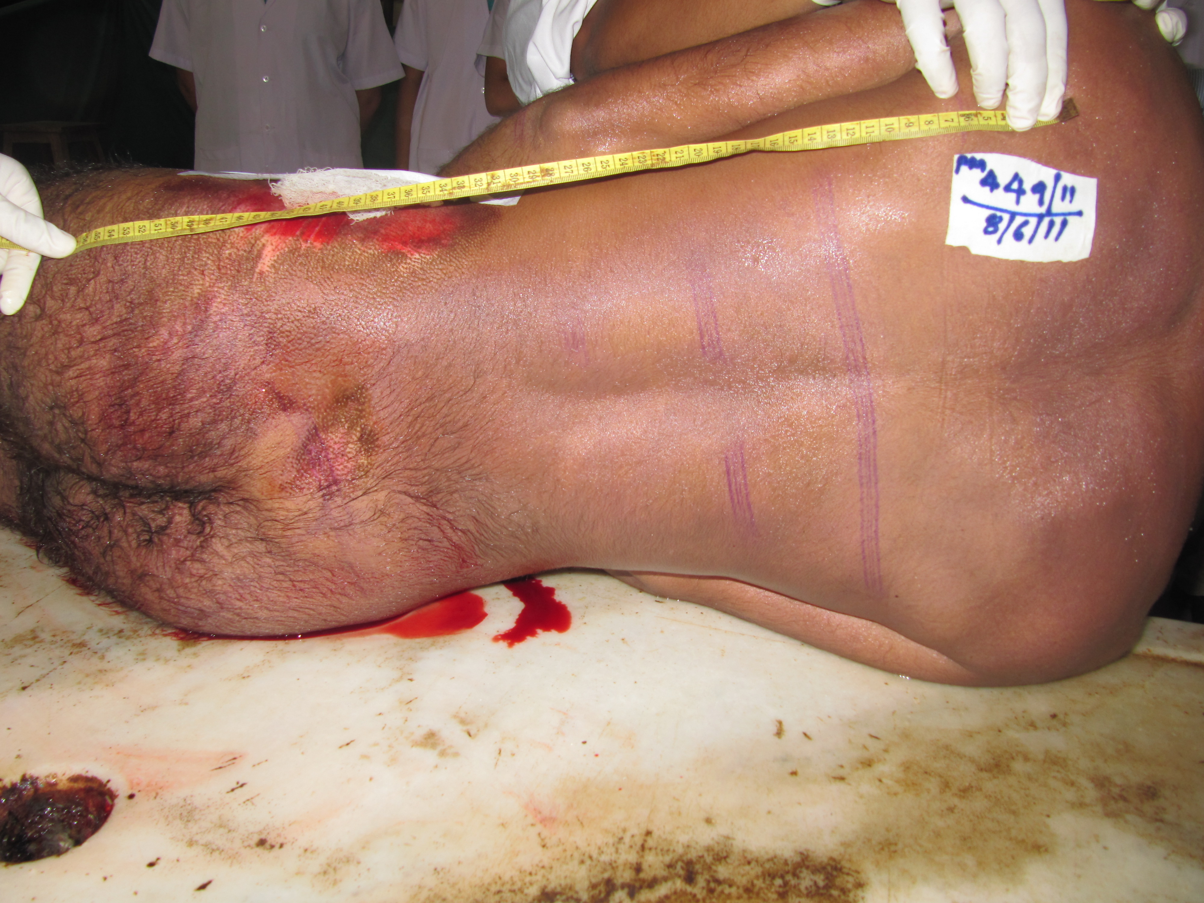 poster 3 - Spinal cord comes along the removal of brain. Postmortem artifact: Any taker?