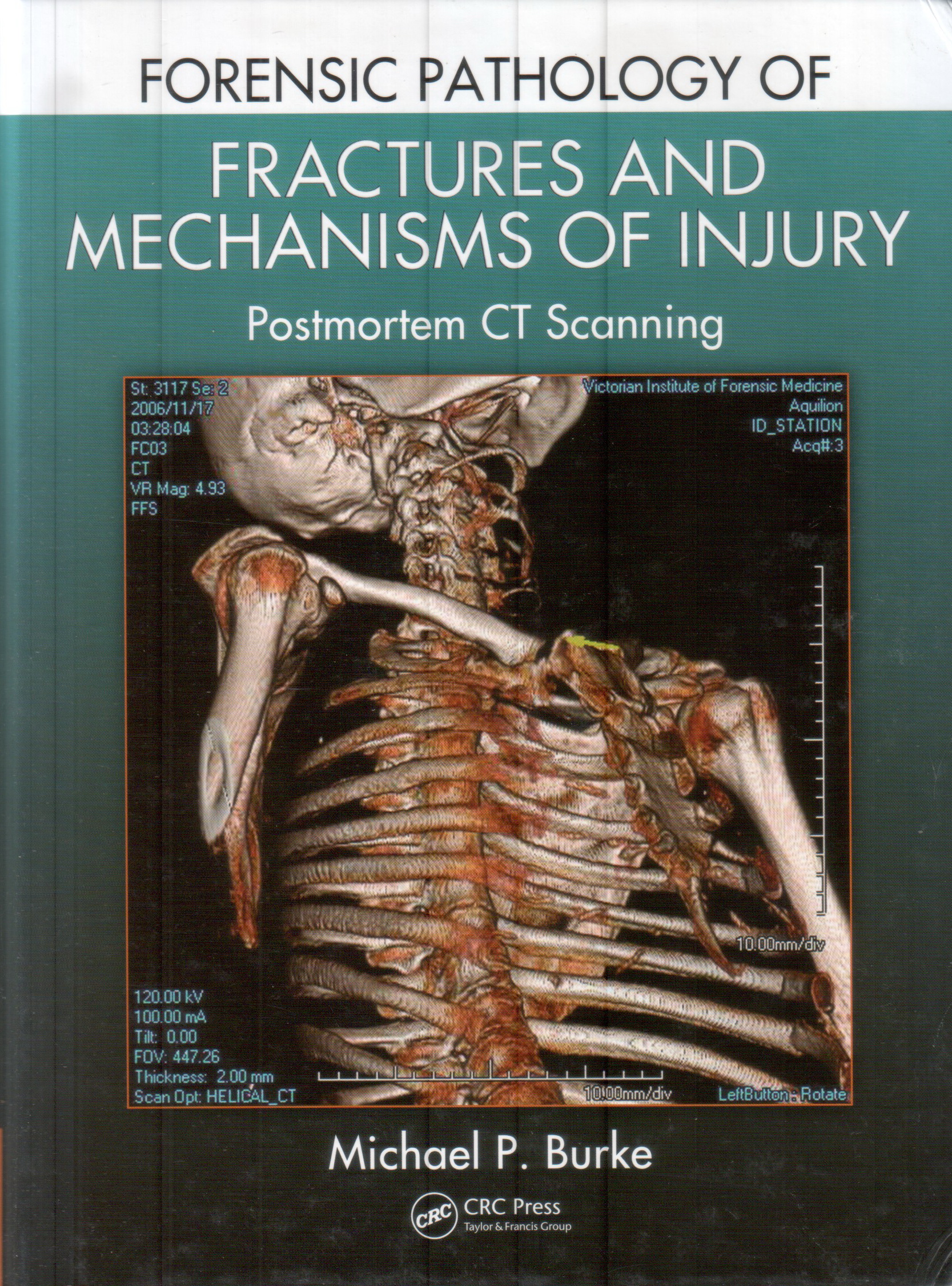Forensic Pathology of Fractures and Mechanisms of Injury-Postmortem CT Scanning, 1st Ed by Michael P. Burke